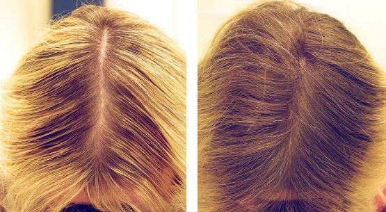 Мезококтейли для волос против выпадения в домашних условиях