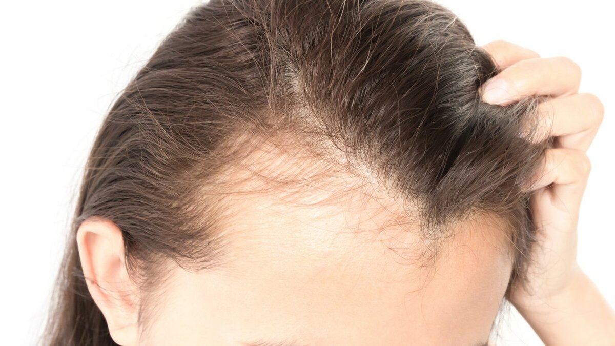 Советы врача-трихолога: как остановить выпадение волос! | интернет-cолянка