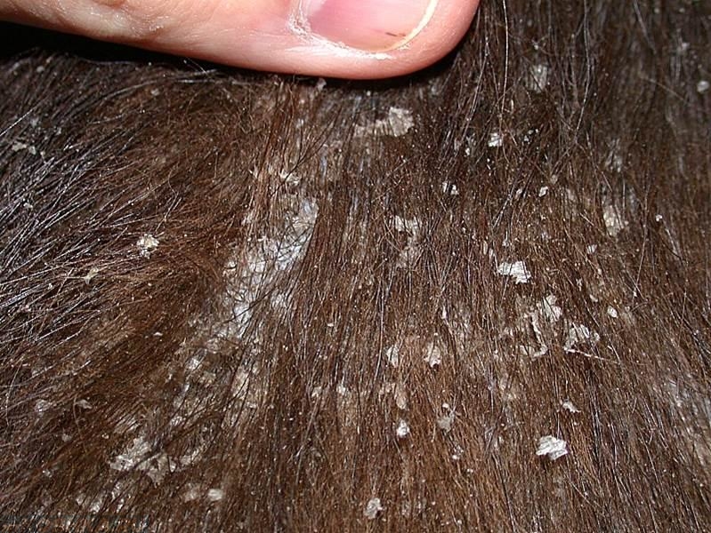 Сухая себорея кожи головы: симптомы, лечение, фото