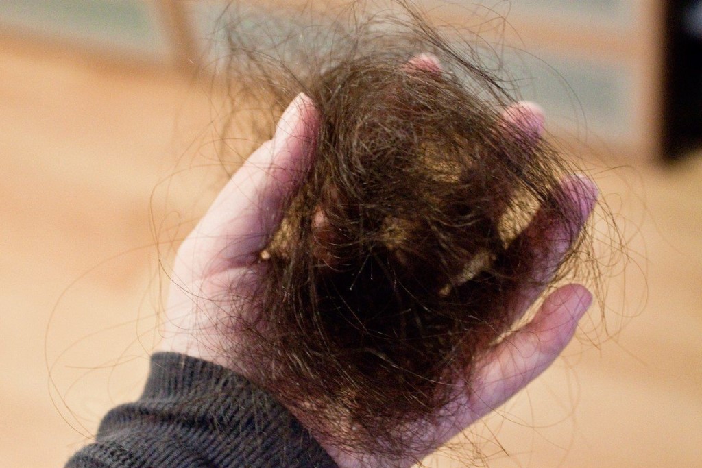 Лечение гормонального выпадения волос у женщин - как остановить?