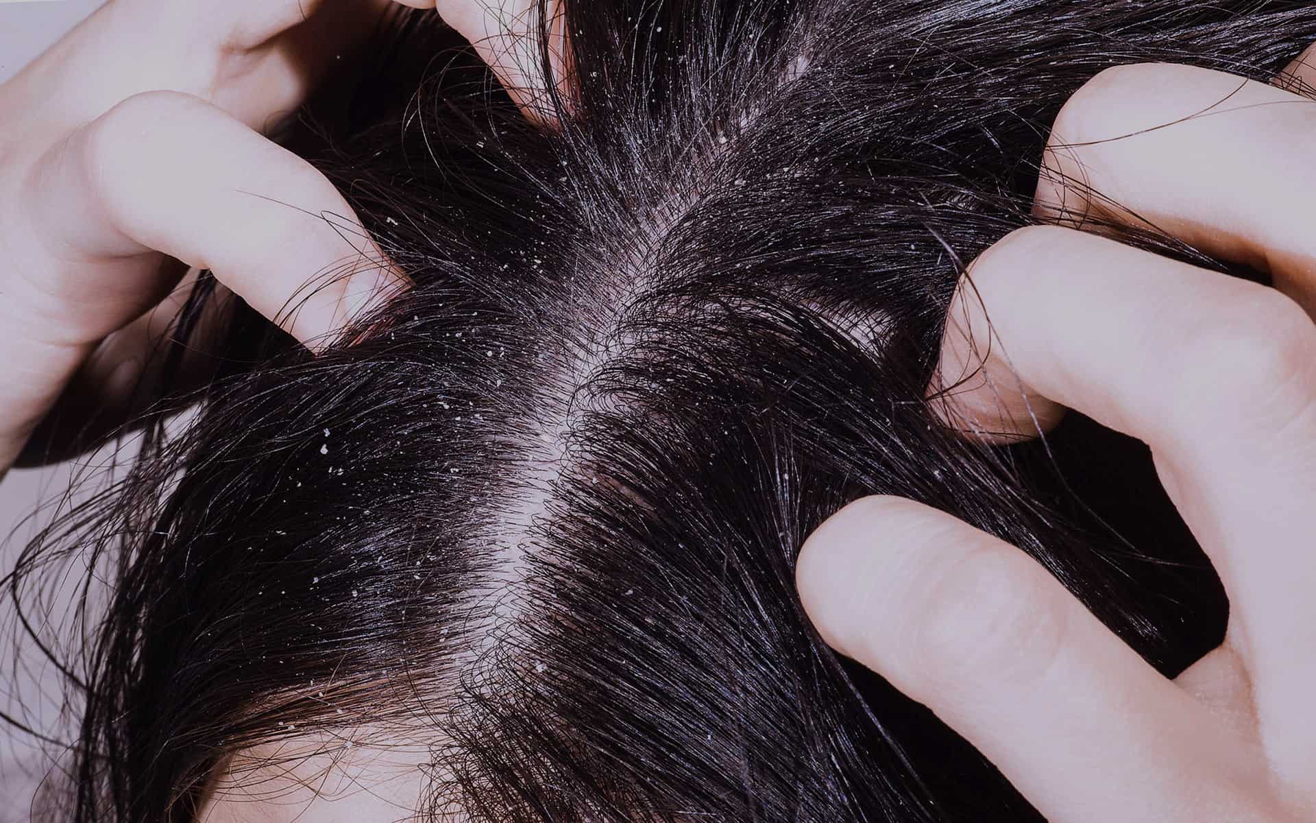 Перхоть: 2 главные причины её появления, лечение, профилактика | волосок