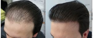 Пересадка волос у мужчин, фото