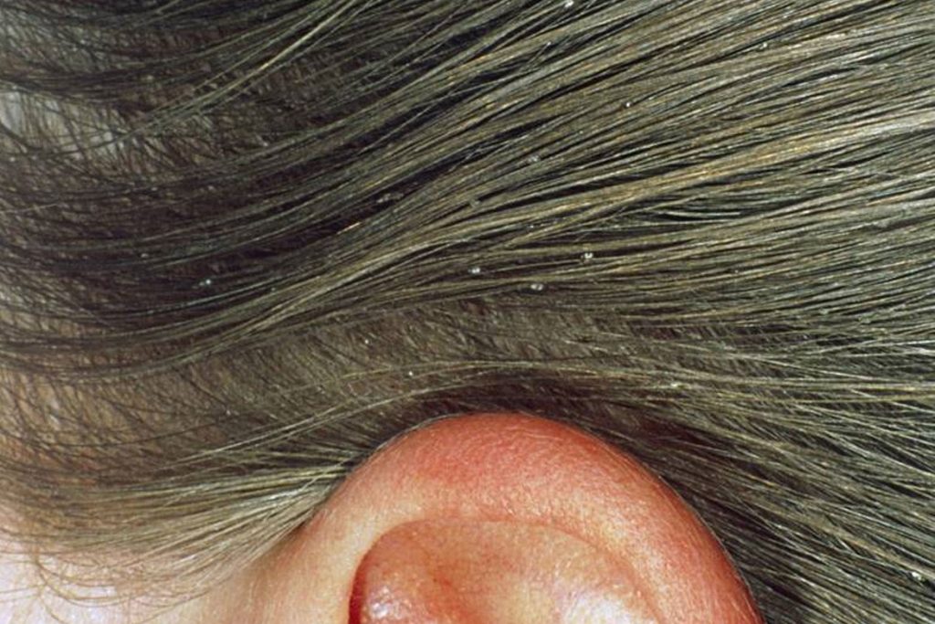 Гниды на волосах: что это, как выглядят, откуда берутся и чем лечить - как появляются