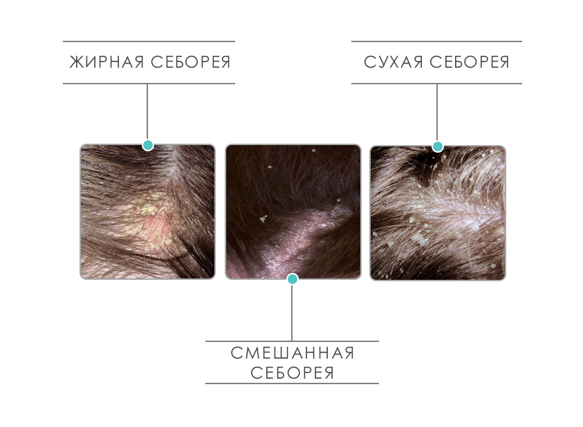 Себорея кожи головы: лечение в домашних условиях, обзор методов
