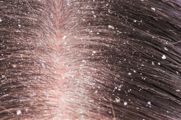 Себорейный дерматит в волосах на голове: причины, фото, лечение
