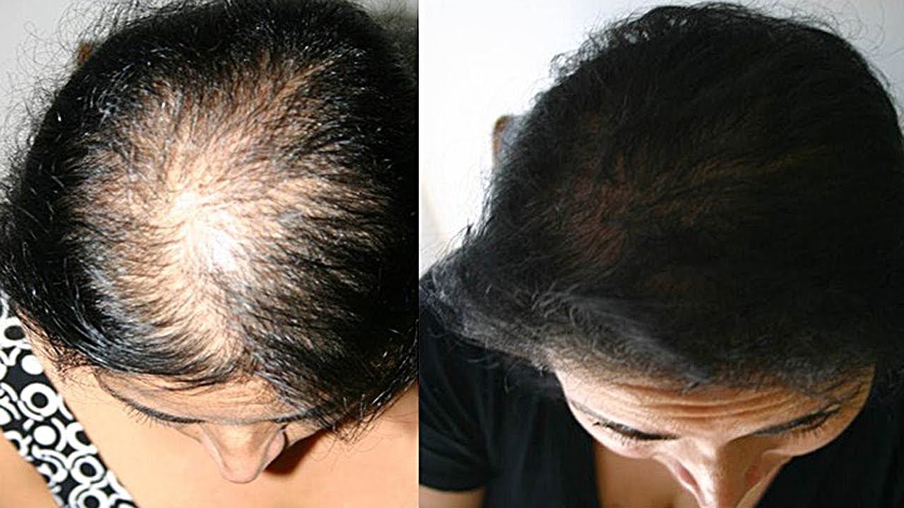 Как остановить выпадение волос при гормональном сбое — волосы