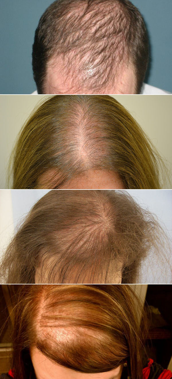 Выпадение волос от стресса - лечение. как остановить стрессовую алопецию