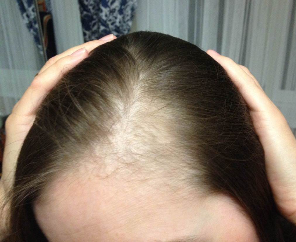 Взаимосвязь выпадения волос с нарушением гормонального фона