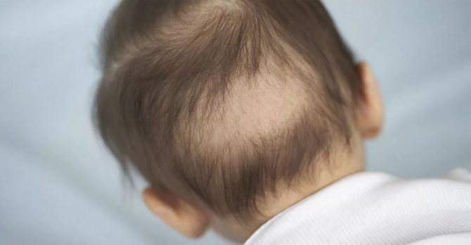 Выпадение волос у месячного ребенка